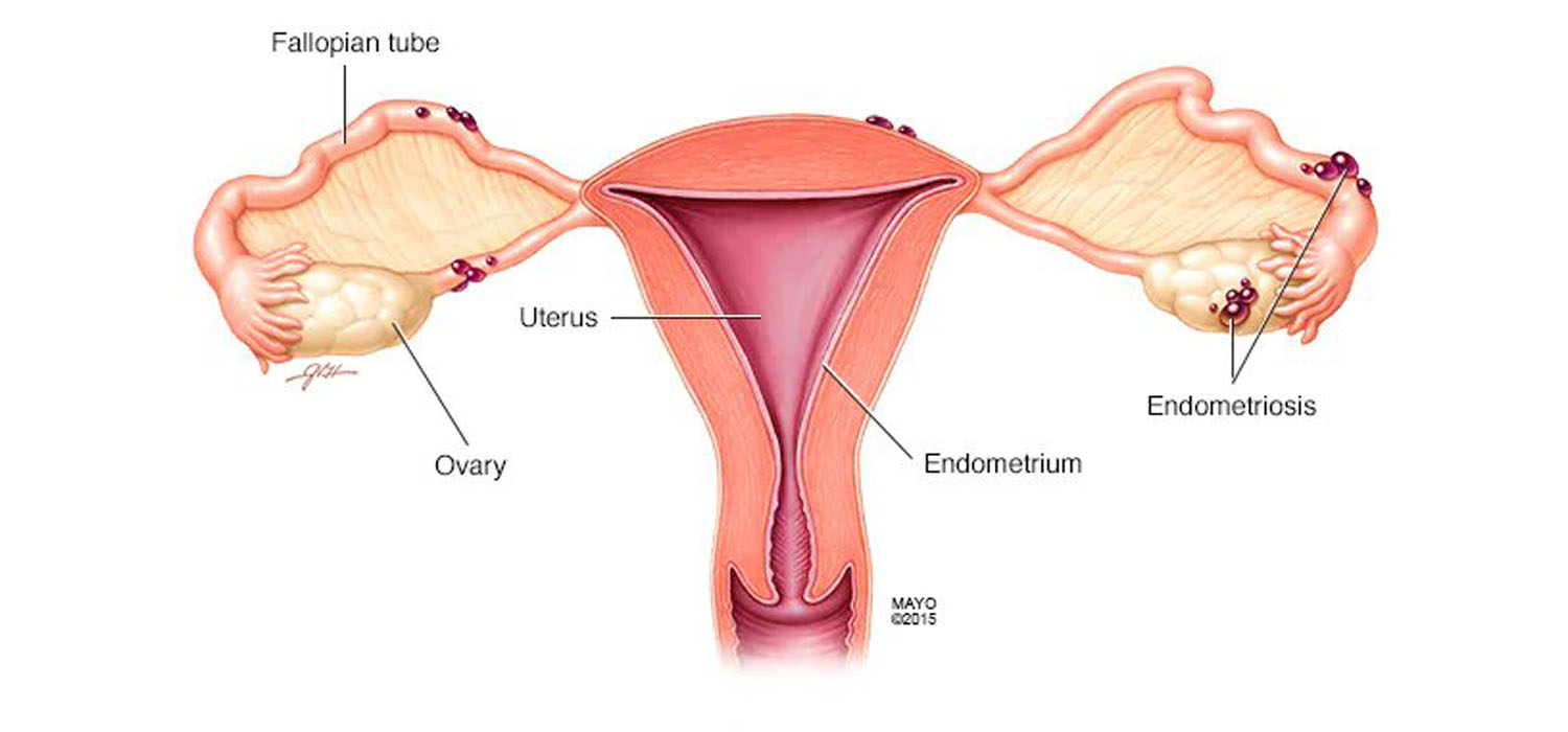 clinical features and diagnosis of endometriosis