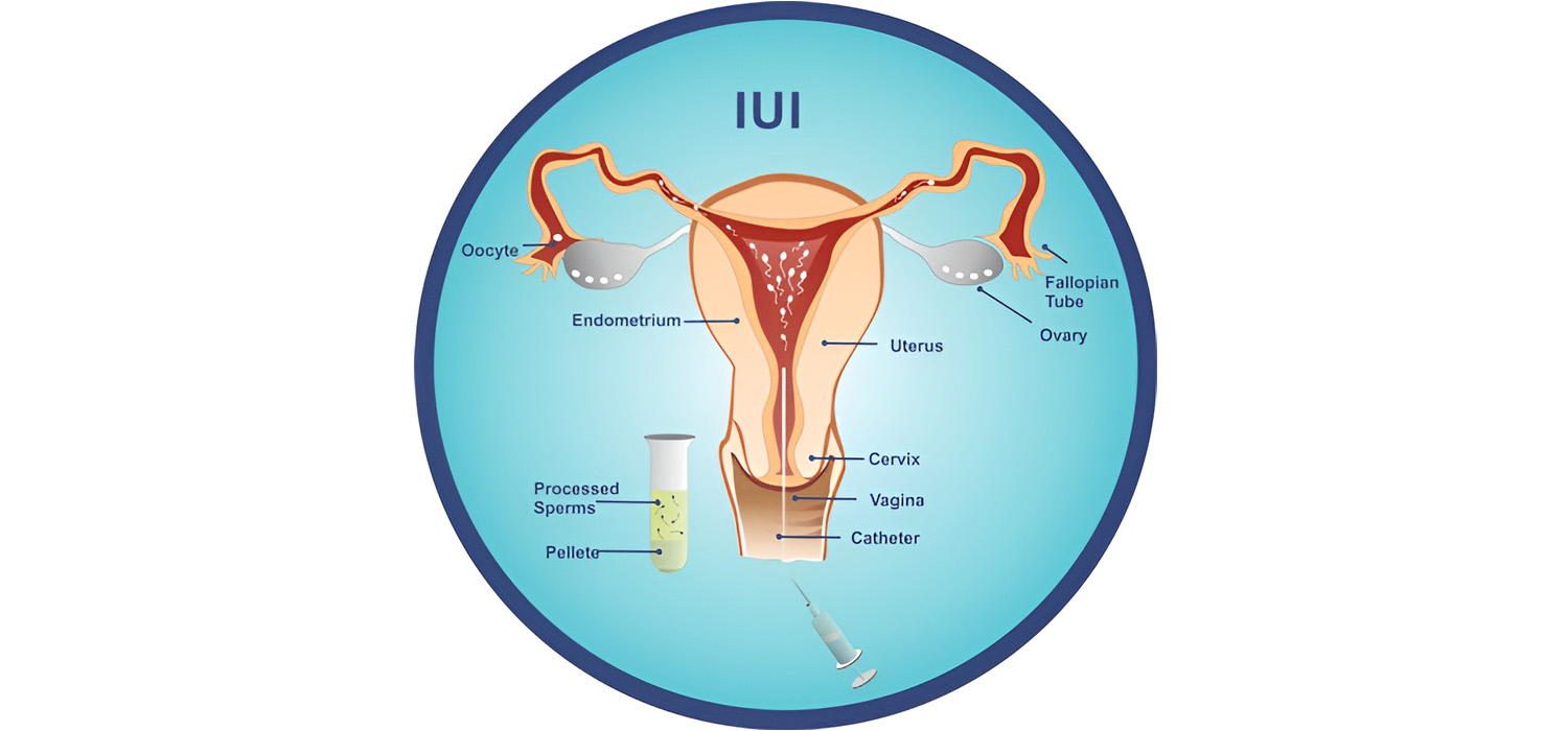 Indications and Contra-indications for IUI