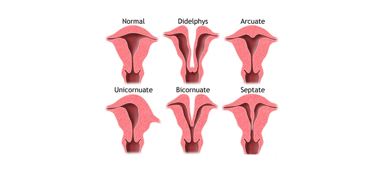 progesterone primed ovarian stimulation