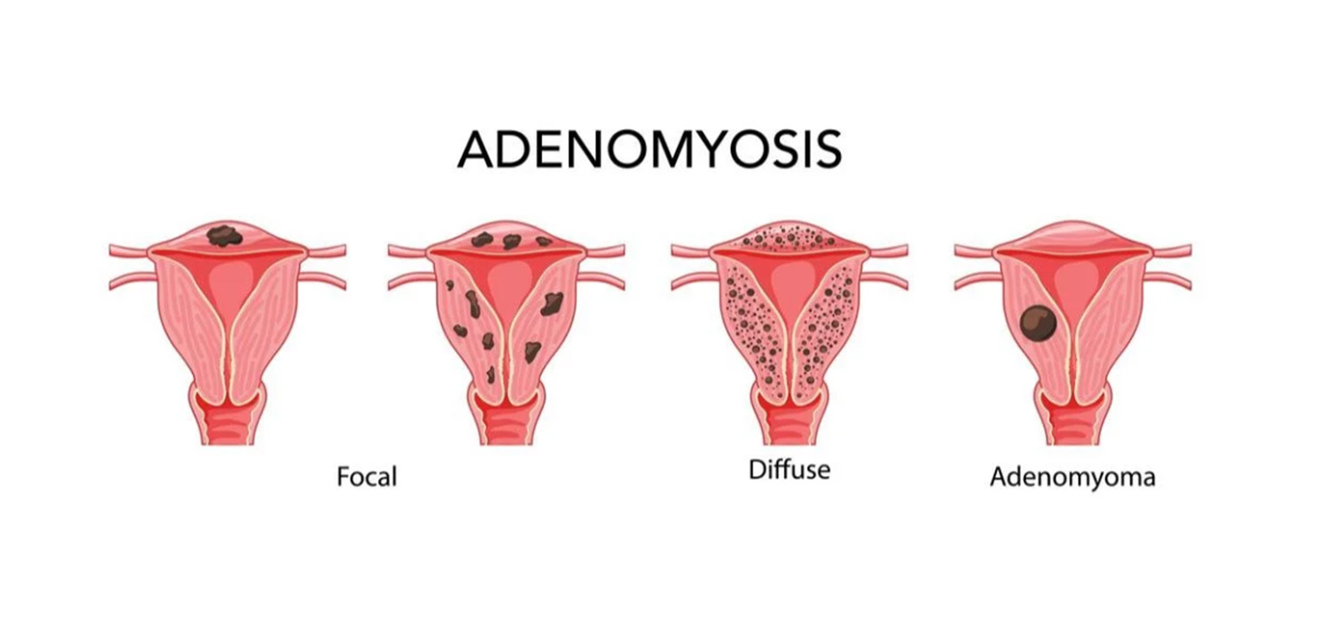 uterine factors in infertility adenomyosis
