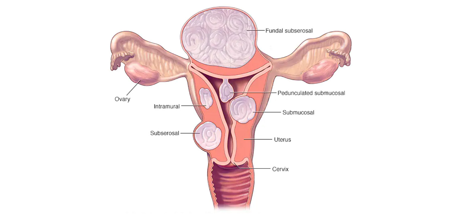 uterine factors in infertility myomas